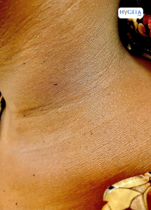 FEMALE NECK WITH SKIN TAGS