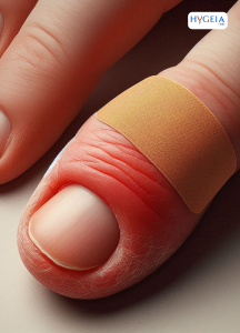 An image of the palm facing down with one of the finger tips swollen from Whitlow